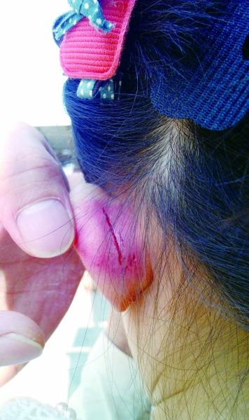 　　女童的耳朵被老師揪裂。圖片由女童家人提供