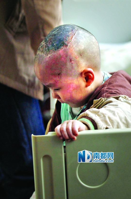 1月8日下午，小寶頭上和臉上都是傷痕。