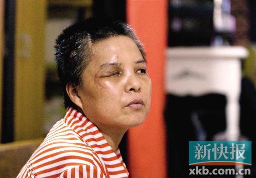 4月初,趙女士遭人搶劫并被打傷,現(xiàn)今右眼失明,頭部被縫100多針。記者 畢志毅/攝