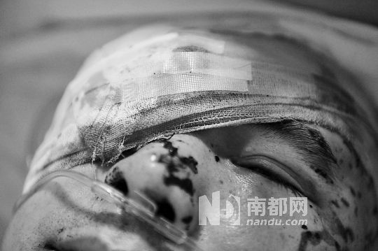 李建新頭部還有被潑硫酸的痕跡，醫(yī)生說被砍傷的右眼已經(jīng)失明。 南都記者 田飛 攝