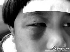6月2日，網(wǎng)曝渭南市臨渭區(qū)一不滿5歲的女童遭奶奶毆打，眼圈青腫，引起網(wǎng)友關(guān)注，但孩子父母和爺爺均稱是摔倒導(dǎo)致。相關(guān)部門介入調(diào)查發(fā)現(xiàn)確為奶奶毆打所致，鑒于其身體原因已進行批評教育。