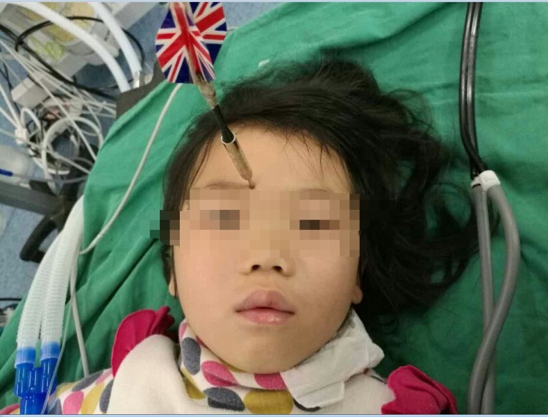 十多公分長的飛鏢穩(wěn)穩(wěn)地 ” 定 ” 在了一名六歲半的女童額頭上，小青一家人凌晨從長順趕到貴醫(yī)附院急診室時，看到如此慘烈的情況，接診醫(yī)生都嚇了一跳。詳細詢問下得知，原來是七歲的哥哥和六歲半的表妹在玩耍時，哥哥不慎將路邊撿來的真飛鏢扎到了妹妹的額頭上。