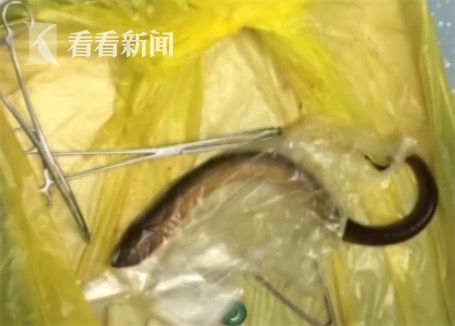 黃鱔從肛門(mén)鉆進(jìn)肚子 男子被送醫(yī)不愿多談事情經(jīng)過(guò)