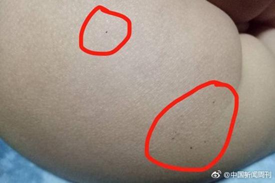 據(jù)多名紅黃藍(lán)(新天地分園)家長(zhǎng)反映，孩子腿部、屁股、腋下出現(xiàn)針眼。