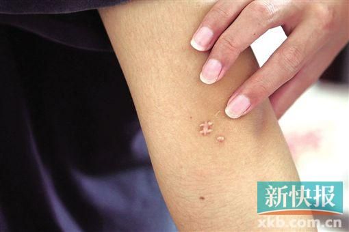 取出針后李星兒手臂留下了傷口。新快報(bào)記者 張國(guó)鋒/攝