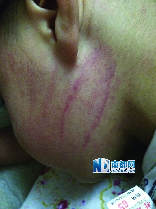 小逸臉上淤痕清晰可見。