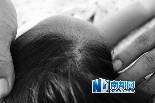 女童頭上被扎的針孔（圓圈處）。賈先生說，被扎不到三秒鐘，女兒就昏了。