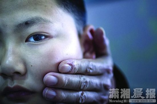 1月13日，小玨的父親心疼地摸著兒子的臉。
