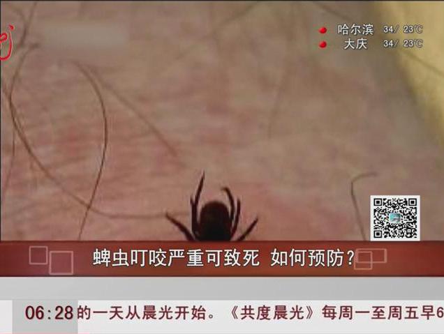 蜱蟲叮咬嚴重可致死如何預防？