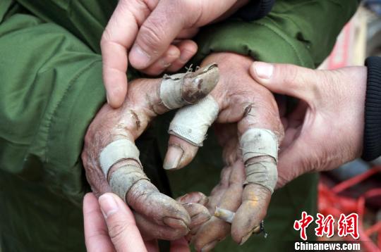 圖為由于常年拾荒，老人雙手布滿傷口。周小云 攝